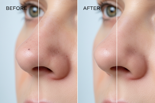 Résultats avant et après utilisation du nettoyeur de pores AcnéAway